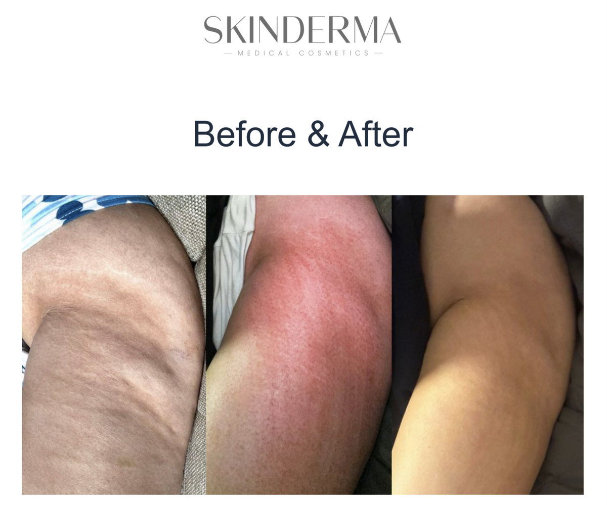 SKINDERMA Cellulite Combo 5 X 10ml